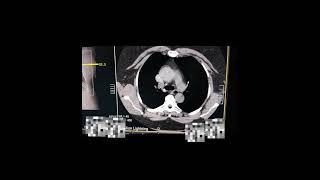 Angiotomografia das Artérias Pulmonares  Protocolo TEP Canon 16 canais [upl. by Muhcan]