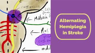 Alternating Hemiplegia in Stroke [upl. by Thomasina]