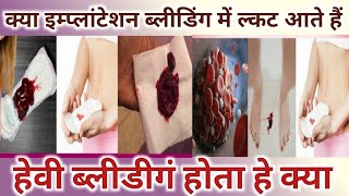 Kya Implantation bleeding me clots aate hai।Heavy Bleeding hoti hai।Implantation Bleeding Vs Periods [upl. by Angelina]