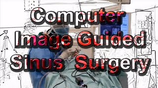 Image Guided Sinus Surgery Computer Navigation for sinus surgery [upl. by Eeraj]