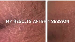 Microneedling Stretch Marks Treatment Before and After [upl. by Adnilra]