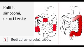 Kolitis simptomi uzroci i vrste [upl. by Kelby]