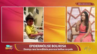 Epidermólise Bolhosa doença rara e hereditária provoca bolhas na pele [upl. by Edlitam652]