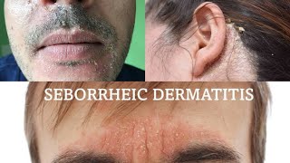 Seborrheic dermatitis  treatment health [upl. by Dric]