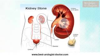 Treatment For Kidney Stone in Bangalore  Kidney Stone Removal in Karnataka  Urology Hospital India [upl. by Eilime]