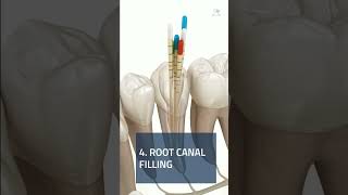 ROOT CANAL TREATMENT STEP BY STEP EXPLAINED 🧐🦷 shorts [upl. by Ahtebbat]