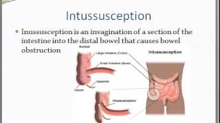 Intussusception and Volvulus [upl. by Dimphia]