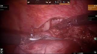 Robotic Resection of Schwannoma [upl. by Mayrim]