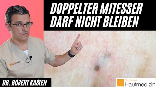 Doppelt endender Mitesser Darf nicht bleiben  Dr Kasten Hautmedizin in Mainz mitesser [upl. by Sigismondo69]