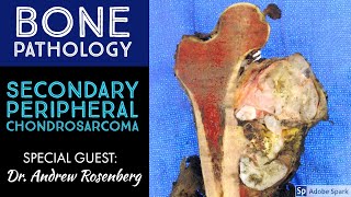 Secondary Peripheral Chondrosarcoma from OsteochondromaExostosis Bone Pathology with Dr Rosenberg [upl. by Adlihtam]