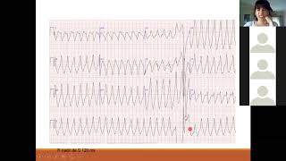 M6P2 Curso de electrocardiografía clínica “Prof Hiram Collard”  Cát de Semiología HNCFCMUNC [upl. by Metts872]