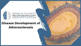 Disease Development of Atherosclerosis [upl. by Sivrup]