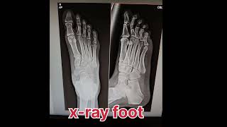 x ray of foot radiology shortvideo [upl. by Bagley]