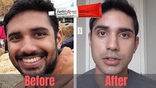 RetinA Tretinoin 6 Month Progress  Tips and Tricks for Starting [upl. by Levins]