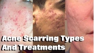 HOW TO TREAT ACNE SCARRING Remove Mild Moderate amp Severe Acne Scars [upl. by Keller]