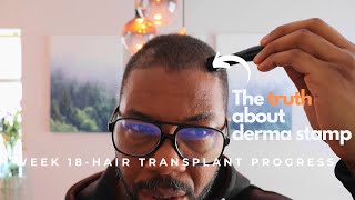 Week 18   month 4  Turkey Hair transplant The derma stamp [upl. by William]