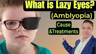 What is Lazy EyesAmblyopia Causes and Treatments of Lazy Eyes  Lazy Eyes kya hota hai [upl. by Mauro]