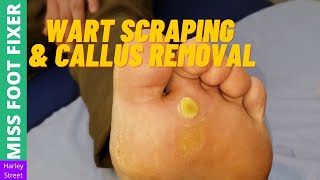 Wart Scraping amp  Bottom Callus Removal   Miss Foot Fixer [upl. by Brost]