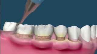 Raspado y alisado radicular  Periodoncia [upl. by Betti]