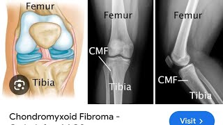 chondroblstoma Vs chondromxoid fibroma [upl. by Ferrand658]