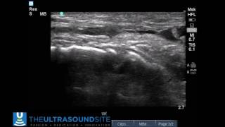 Tibialis Anterior Rupture II [upl. by Ellegna376]