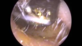 191 BEATING Eardrum visible after simple Ear Wax Removal  Mr Neel Raithatha The Hear Clinic [upl. by Eseilana]