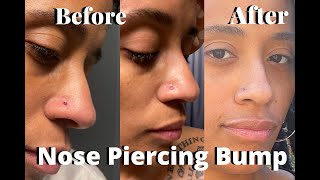 How to get rid of a nose piercing bump  My Journey [upl. by Ivah]