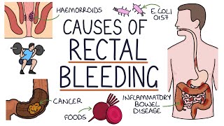 Understanding the Causes of Blood in Stool Rectal Bleeding [upl. by Hilde]