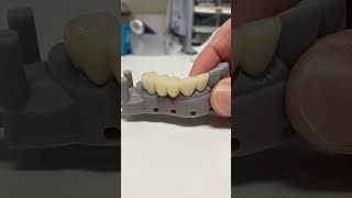 🦷🔥 Dental Bridge for a Patient [upl. by Ayim]