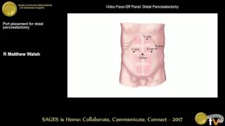 Port placement for distal pancreatectomy [upl. by Rickie919]