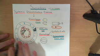 Sarcoidosis Part 1 [upl. by Adriana]