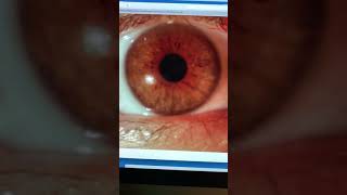 Severe contact lensrelated infectious keratitis scar Kanellopoulos MD [upl. by Earesed]