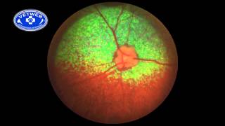 SARDS Sudden Acquired Retinal Degeneration Syndrome [upl. by Drawde673]