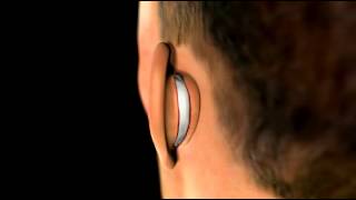 Ear Plastic Surgery  3D Medical Animation  ABP © [upl. by Alansen696]