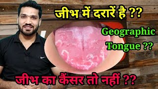 जीभ में दरारें धब्बे क्यों है  कैन्सर  Geographic tongue Causes symptoms amp Treatment [upl. by Gilbertson]