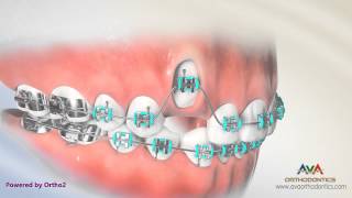 Orthodontic Treatment for Impacted Canine  Laser Exposure [upl. by Gnanmos658]