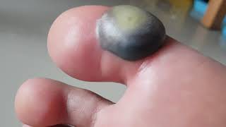 Treating Blisters  Daily Dos of Dermatology [upl. by Kirre]