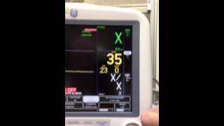 Capnography EtCO2 Monitoring [upl. by Coumas]