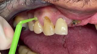 Houston Cosmetic DentistStep by Step removal of gum line decayInvisible restorations [upl. by Sender622]