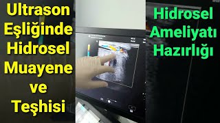 Hidrosel Nasıl Oluşur Ultrasonda Hidrosel Teşhisi Nasıl Konur HİDROSELEKTOMİ AMELİYATI Hazırlığı [upl. by Engamrahc966]