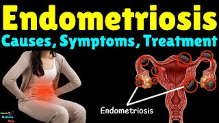 Endometriosis Causes Symptoms Diagnosis Treatment Complications amp Prevention [upl. by Annecorinne]