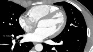 Right Pulmonary Artery on Axial CTA [upl. by Dibrin931]