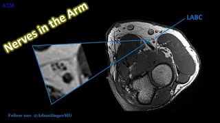 High Resolution MRI Anatomy of Major Nerves in the Arm [upl. by Oidualc598]