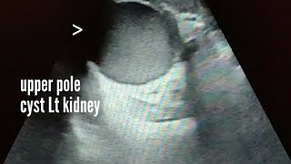 Hemorrhagic cyst left kidney ultrasound and color Doppler video [upl. by Supen]