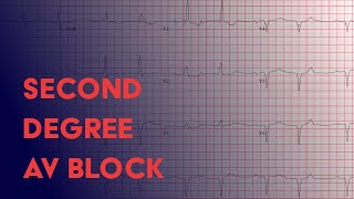 Second Degree Heart Block  Electrocardiogram ECGEKG Interpretation [upl. by Nosyt]