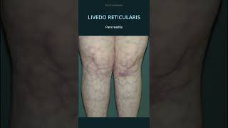 Livedo Reticularis Causes osce practicalmedicine diagnosis sle [upl. by Yelsnit]