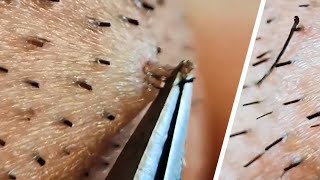 Ingrown hair removal compilation😌 [upl. by Yerhcaz427]