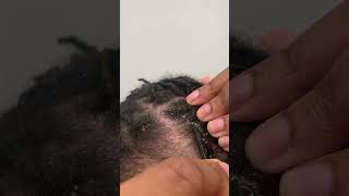 Itchy Scalp  Eczema Flare Up [upl. by Ogg]