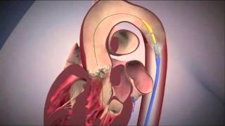 Transcatheter Aortic Valve Replacement Animation [upl. by Kingsly903]