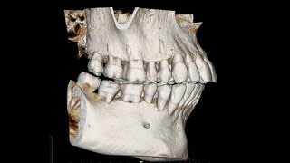 How to create a cephalometric radiograph from CBCT [upl. by Anekahs]